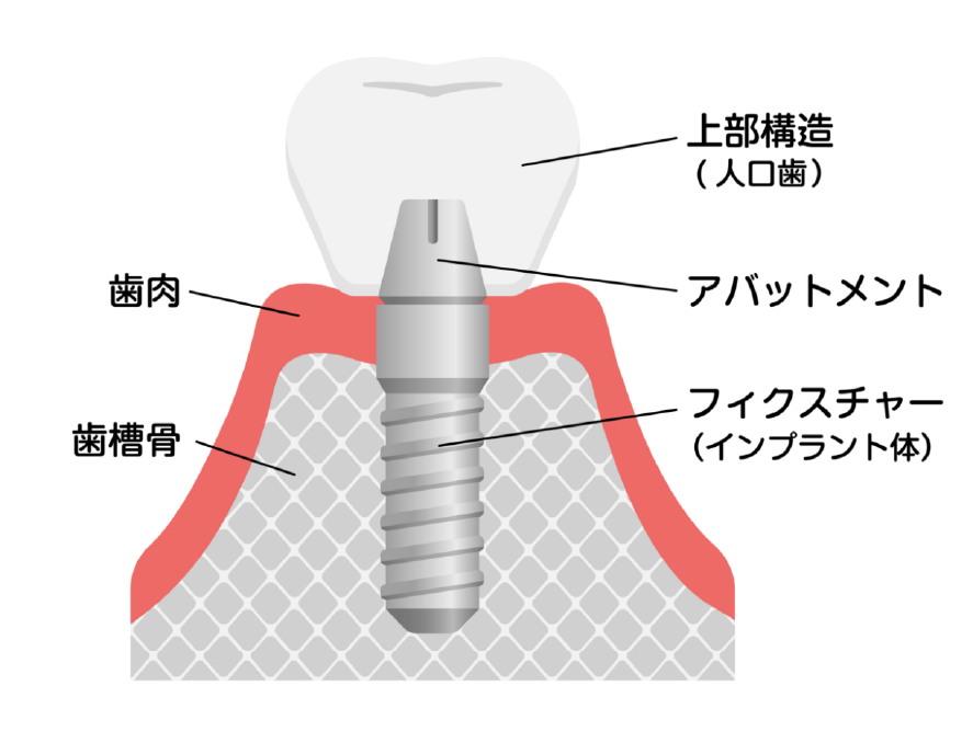インプラント - 千葉県野田市中根の「大人とこどものあおば歯科」
