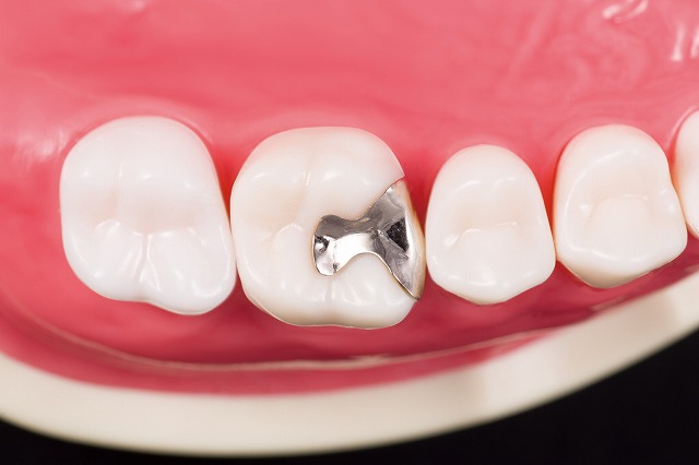 技工物 | Leo歯科クリニック