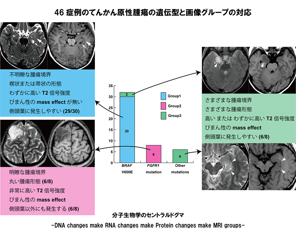 てんかんを起こす脳腫瘍の遺伝子タイプに関連するMRI画像の特徴を発見