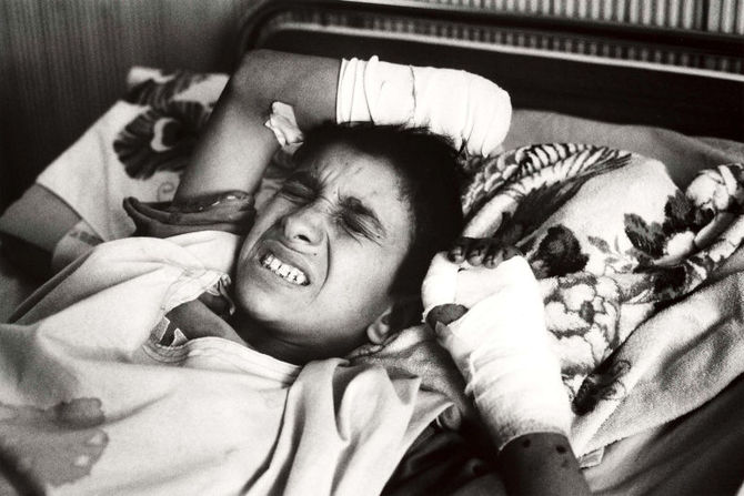 イラク戦争の戦闘に巻き込まれて被弾し両手を負傷した少年＝2003年4月