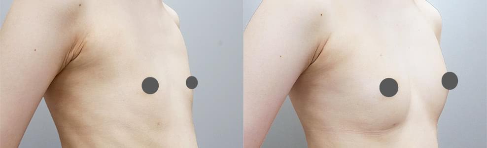 乳房拡張器ビブラを併用した脂肪注入豊胸の症例（21歳/女性）