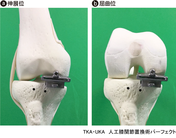 TKA・UKA 人工膝関節置換術パーフェクト〜人工膝関節全置換術・人工膝