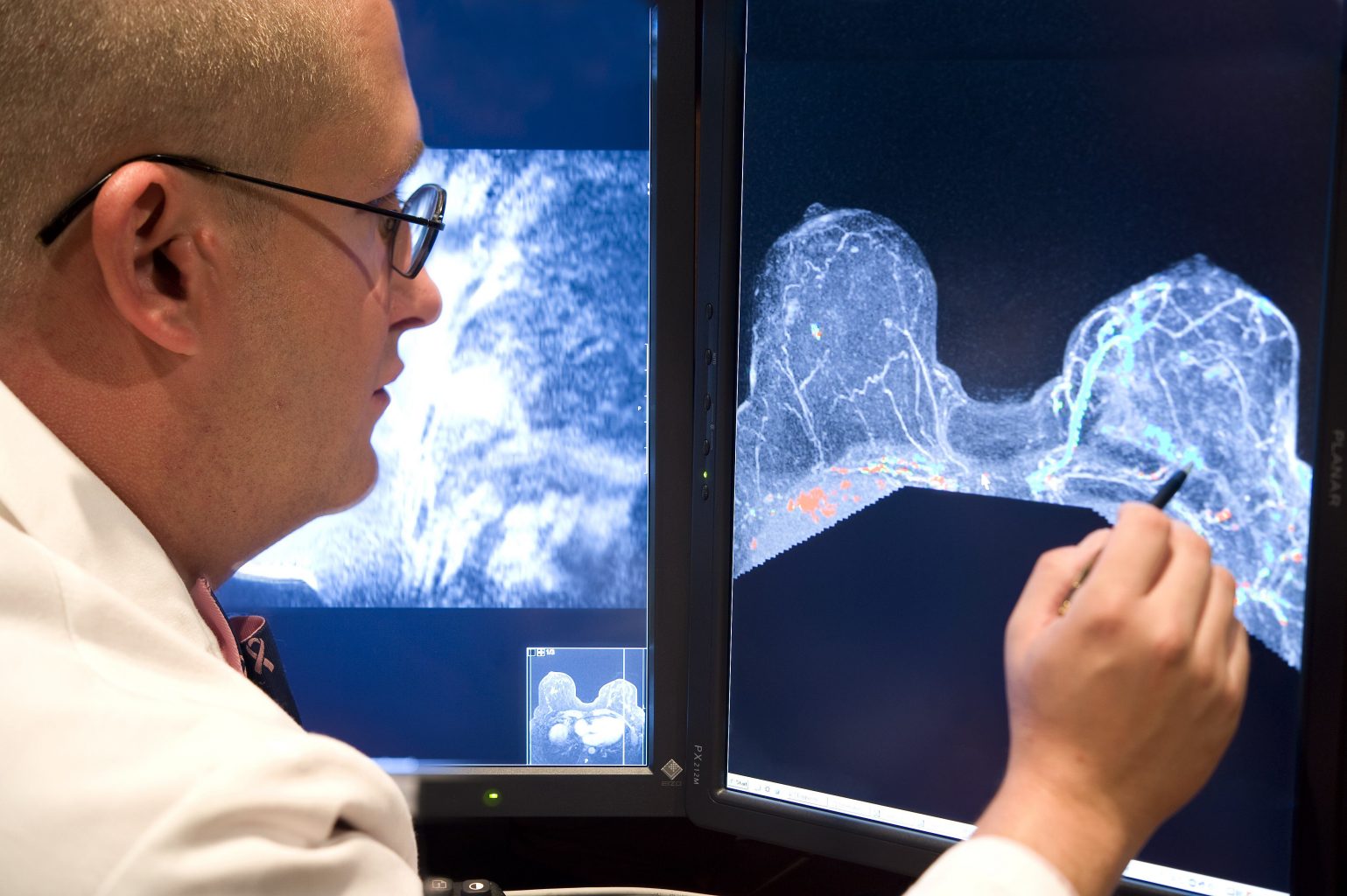 Breast MRI - Magnetic Resonance Imaging,or MRI