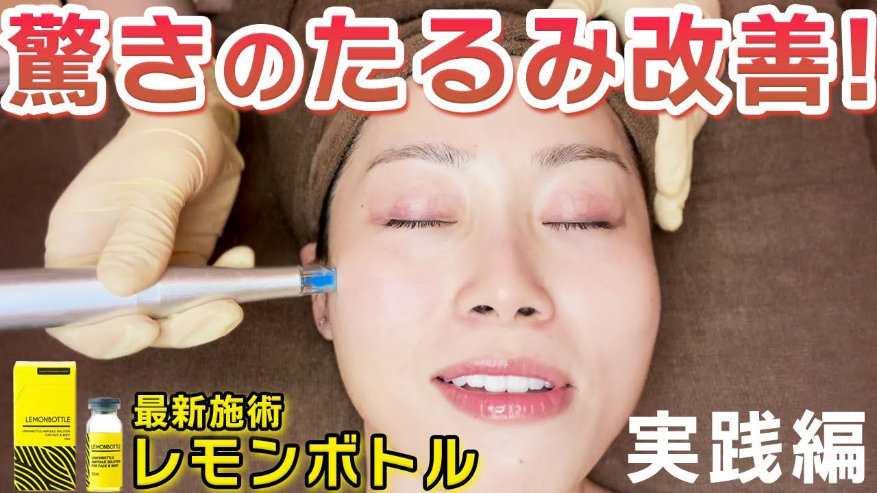 Fat-dissolving injection] The amazing effects of the lemon bottle