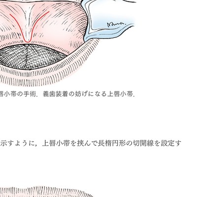 イラストでみる口腔外科手術 第3巻