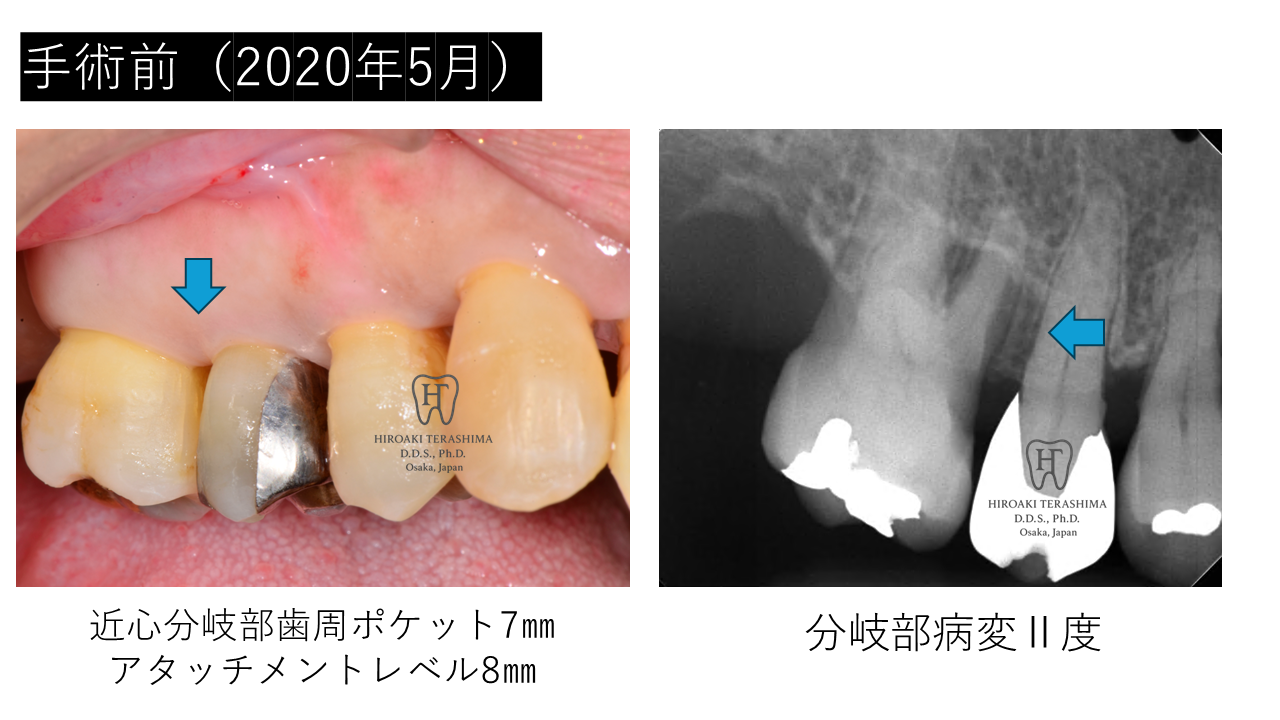 右上6番分岐部病変Ⅱ度に対するリグロスを用いた歯周再生療法 5年経過