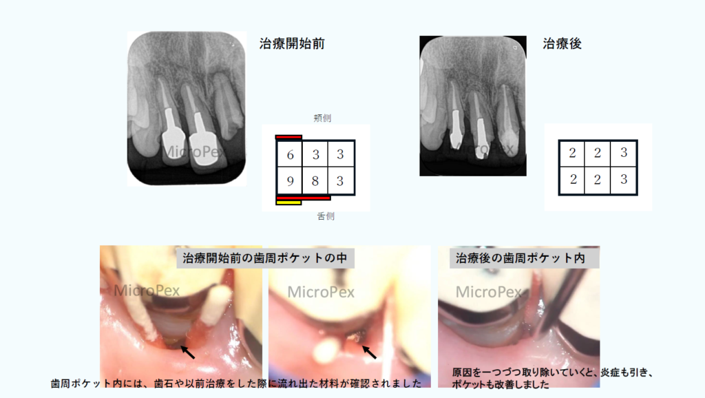 マイクロスコープ根管・歯周治療のページ – Precision Dental Laboratory