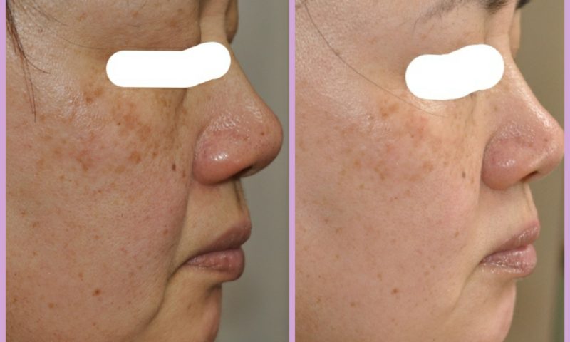 長年施術に使用されている効果の高いラジオ波。ラジオ波の基礎知識