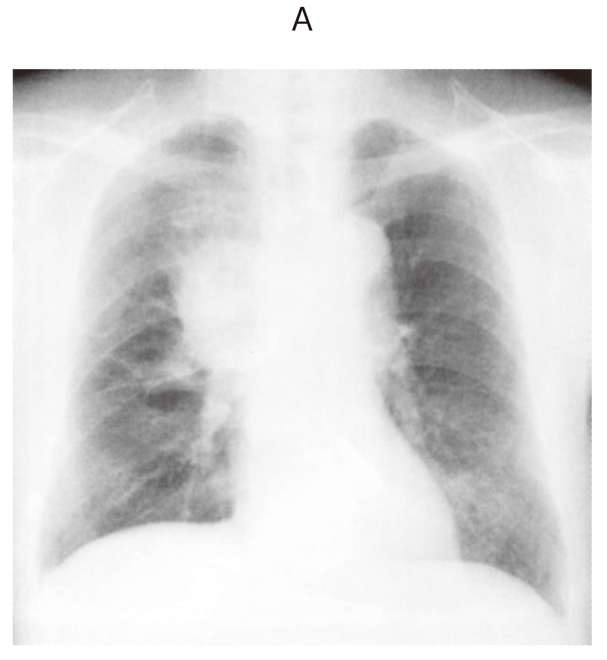 99F46 | 肺小細胞癌, 上大静脈症候群 国試 | テコプラ