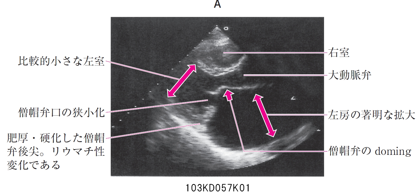 103D57 | 僧帽弁狭窄症 国試 | テコプラ
