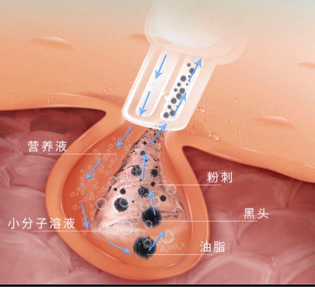 ハイドロスプラッシュ ハイドラフェイシャル